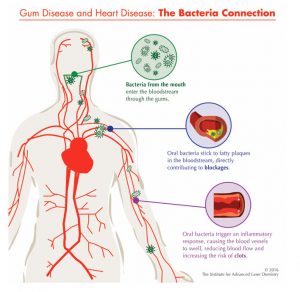 Gum-&-Heart-Disease